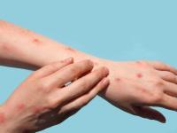 Mpox outbreak worsens in South Africa: What you need to know about symptoms and spread