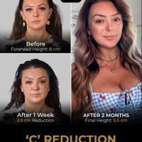 Forehead Reduction Surgery in Turkey: Creating Natural Facial Balance