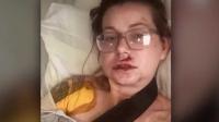 Milwaukee woman severely injured after scooter hits pothole