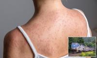 Measles nightmare for Amtrak as potential super-spreader sparks alerts from Colorado to California