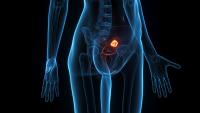 <![CDATA[Relacorilant Combo Receives Positive CHMP Opinion in Ovarian Cancer]]>