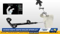 Mercy Medical Center: How new robotic technology is changing shoulder surgery