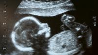 California’s Misguided Attack Against Abortion Pill Reversal