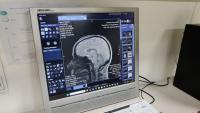 14 psychiatric disorders have 5 gene clusters in common, Colorado study finds