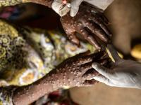 Many cases of mpox in DRC thought to be false diagnoses, say Swiss researchers