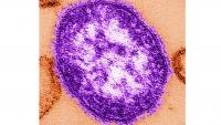 Health officials warn of measles exposure in St. Louis, Pacific, Chesterfield