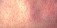 Wisconsin measles cases top 190: Who needs an MMR booster