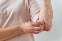 Mpox in South Africa: What you need to know about symptoms, spread, and treatment