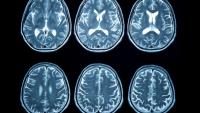 Stroke Rates in Younger Americans Have Nearly Doubled Since the 90s—and Scientists Can’t Fully Explain It