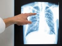 Swiss tuberculosis cases at highest level since 2018