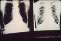 Kentucky’s Gov. Andy Beshear backs black lung bill in Congress