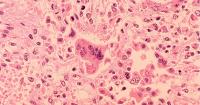 Doctors in Pennsylvania estimate at least six babies have been born with measles