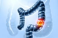 Why are more younger adults in the Eastern Mediterranean facing colorectal cancer?