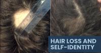Business Spotlight: Alopecia Areata awareness and hair loss education