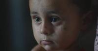 Children face skin disease crisis in Gaza tent camps