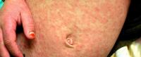 Measles is making a comeback. Will we end it for good?