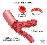 FG pledge commitment to end sickle cell disease