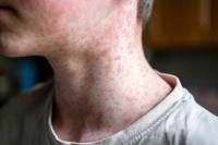 Gates-Backed Outlet Links World Cup Travel to Measles Spread Across Americas