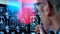 NHS Pilots Rapid Genomic Test for Brain Tumours