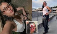 Woman has part of her forehead BITTEN OFF by ranting stranger who called her 'the inferior race' on Democrat-city street