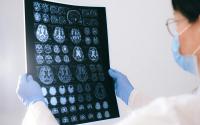 Kazakhstan sees more than fivefold surge in Alzheimer’s patients since 2021