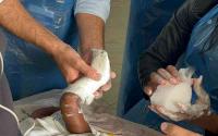 The hidden burden behind Kenya's 2,000 clubfoot births
