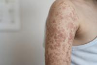 Pennsylvania Measles Outbreak Tops 900 Cases as Hospitalizations Climb in Worst Resurgence in Decades