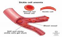 Nigeria should drive home-grown sickle cell solutions – Foundation