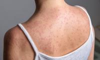 Measles cases surge past 3,600 as a quarter are recorded in Pennsylvania... while CDC FINALLY registers two deaths amid controversy over tally