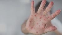 Pennsylvania health workers bring vaccines to communities amid measles outbreak