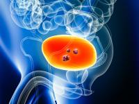 Scientists Develop Simple Test That Detects 95% of a Common Cancer in Study