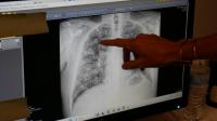 Black lung disease is the only true comeback for coal