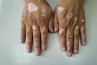 Pfizer Pill’s Phase 3 Data in Vitiligo Pave Way for FDA, EMA Submissions
