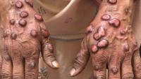 New IL-4 Inhibitor Found Effective for Prurigo Nodularis