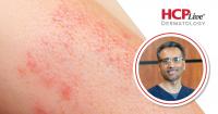 Phase 3 Ritlecitinib Results in Vitiligo, With Iltefat Hamzavi, MD