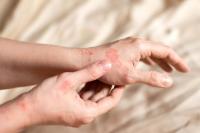 <![CDATA[Delgocitinib Shows Real-World Effectiveness and Improved Quality of Life in Chronic Hand Eczema]]>