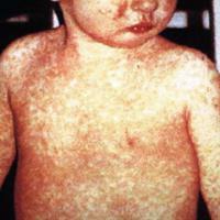 Public Health Notice: Measles Exposure in Fergus County