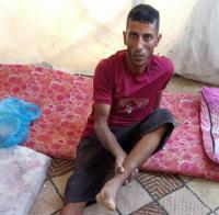 Shrapnel severed his toes: Injured Palestinian father struggles to support family in Gaza