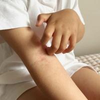 How to treat severe Eczema in hot, humid weather