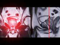 Scientists May Have Found How Aggressive Prostate Cancer Resists Treatment