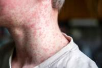 PAHO assesses risk of measles spread as very high ahead of religious mass gatherings in the Americas