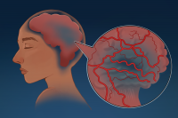 Stroke incidence in younger adults is climbing, UMich researchers find