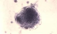 Pennsylvania reports its 6th measles death, in a Franklin County resident