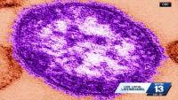 Alabama reports measles case after traveler visits Huntsville businesses