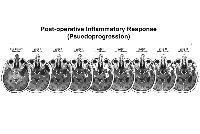 Scientists Identify Clues to Making Immunotherapy More Effective Against Glioblastoma