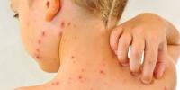 New York declares measles emergency amid rise in cases and spread in rural areas