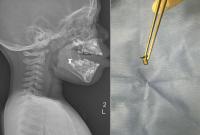 Doctors remove metal screw from two-year-old’s mouth