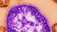 Kentucky health officials urge vaccination amid worst measles outbreak in years