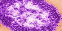 Doctors explain measles exposure risks, hospital response after confirmed Huntsville case