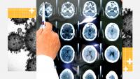 Can brain surgery reverse Alzheimer’s? Plus, new clues about long COVID and the future of health data